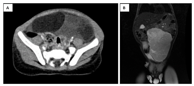 Figura 2. (A) Tomografía computarizada (TC) abdominal: tumoración de 12 x 5 x 12 cm que ocupa desde región subhepática hasta hipogastrio. (B) Resonancia magnética (RM) abdominal: masa centroabdominal de 14 x 15 x 6 cm con efecto masa sobre asas intestinales y vejiga, sin infiltrar estructuras.
