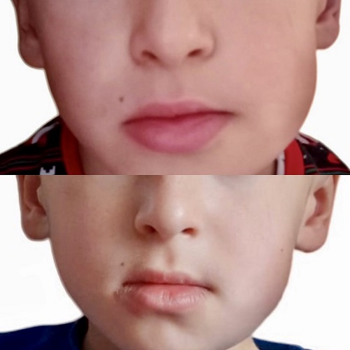 Figura 1. Inflamación rama mandibular izquierda inicial (arriba) y recidiva al mes (abajo).></td>
			</tr>
		</tbody>
		 <caption align=