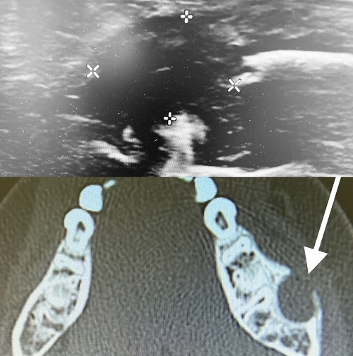 Figura 2. Imagen ecográfica del quiste (arriba, marcas). Tomografía axial computarizada, rompiendo la cortical (abajo, flecha).