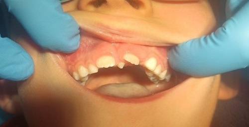 Figura 1. Paciente con mesiodens en línea media interincisiva, posición vertical, que produce la rotación del 21 impidiendo su correcta erupción