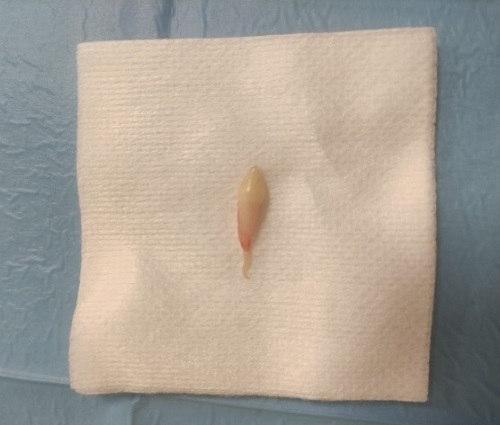 Figura 3. Mesiodens extraído con forma conoide con formación radicular completa y con lesión apical compatible con quiste folicular