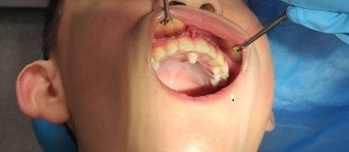 Figura 4. Paciente con mesiodens en línea media interincisal, posición vertical, localización palatina a 2 cm de la cara palatina de incisivos centrales superiores