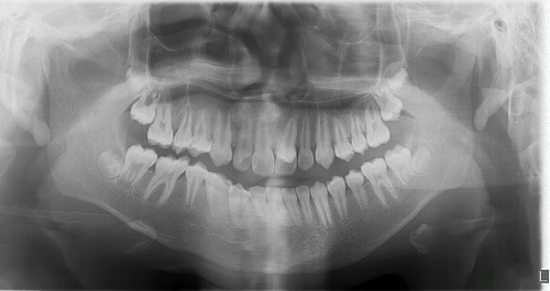 Figura 5. Ortopantomografía. Se observa dentición permanente completa, no hay otros supernumerarios ni agenesias. Presenta supernumerario mesiodens en relación apical con 21 formación radicular completa de incisivos centrales y de mesiodens
