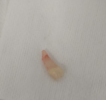 Figura 6. Mesiodens extraído único tuberculado sin lesiones periapicales