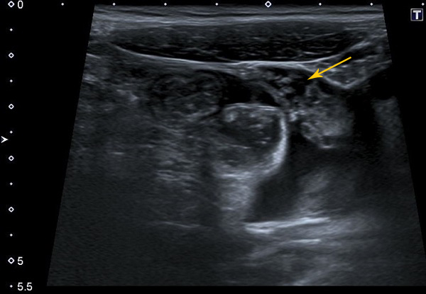 Figura 1. Torta omental (omental cake). Ecografía abdominal, en la que se evidencia un notable engrosamiento edematoso del omento mayor, localizado en fosa iliaca izquierda.