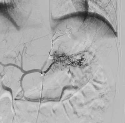 Figura 2. Lesión de Dieulafoy. Resultado final de la embolización