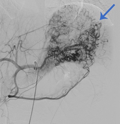 Figura 1. Malformación arterial gastropancreática con aspecto de ovillo. Irrigación principal a expensas de arteria gástrica izquierda y arteria esplénica. El componente gástrico se comporta como una lesión de Dieulafoy