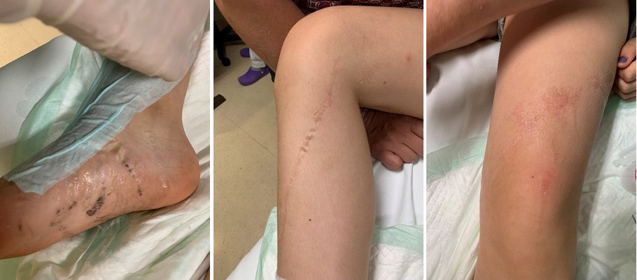 Figura 1. Piel con pegamento, previa a la retirada del mismo.