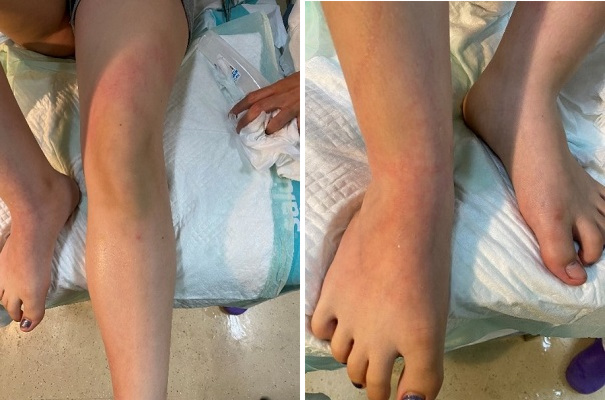 Figura 2. Piel tras la retirada del pegamento.