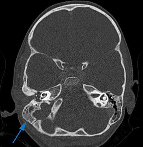 Figura 2. Imagen en TAC en la que se aprecia ausencia de ventilación en la mastoides derecha
