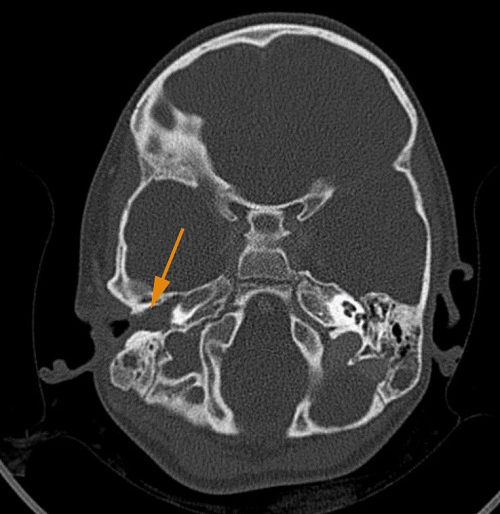 Figura 1. Imagen en TAC en la que se aprecia ocupación del oído medio derecho