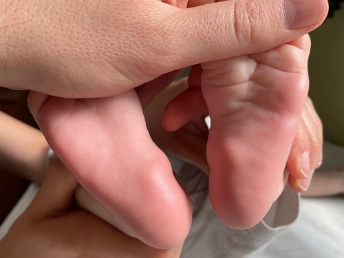 Figura 1. Lesiones nodulares, de bordes mal definidos, de consistencia blanda, en la cara plantar de ambos pies