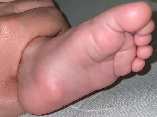 Figura 2. Lesión nodular única en la cara plantar de pie izquierdo