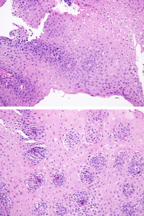 Figuras 3 y 4. Normalización de las biopsias esofágicas tras el tratamiento con dupilumab