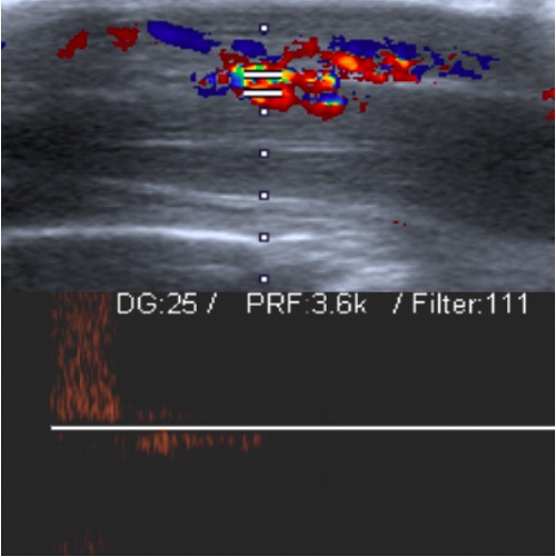 Figura 1. Ecografía Doppler del pene en erección, que muestra flujo arterial y venoso, compatible con fístula arteriovenosa