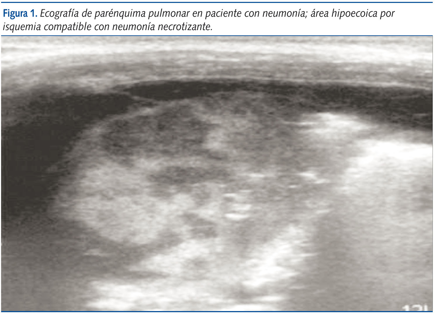 Figura 1. Ecografía de parénquima pulmonar en paciente con neumonía; área hipoecoica por isquemia compatible con neumonía necrotizante.