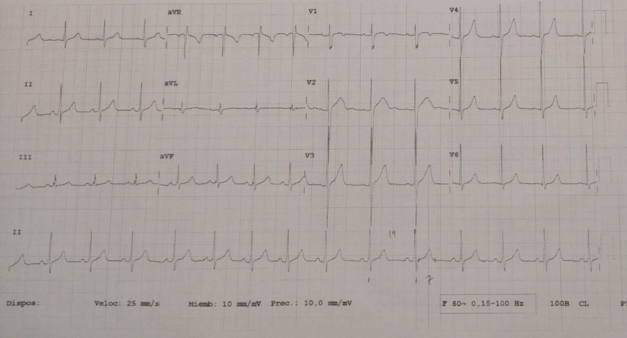 Figura 1. Onda delta en derivaciones II, III y avF