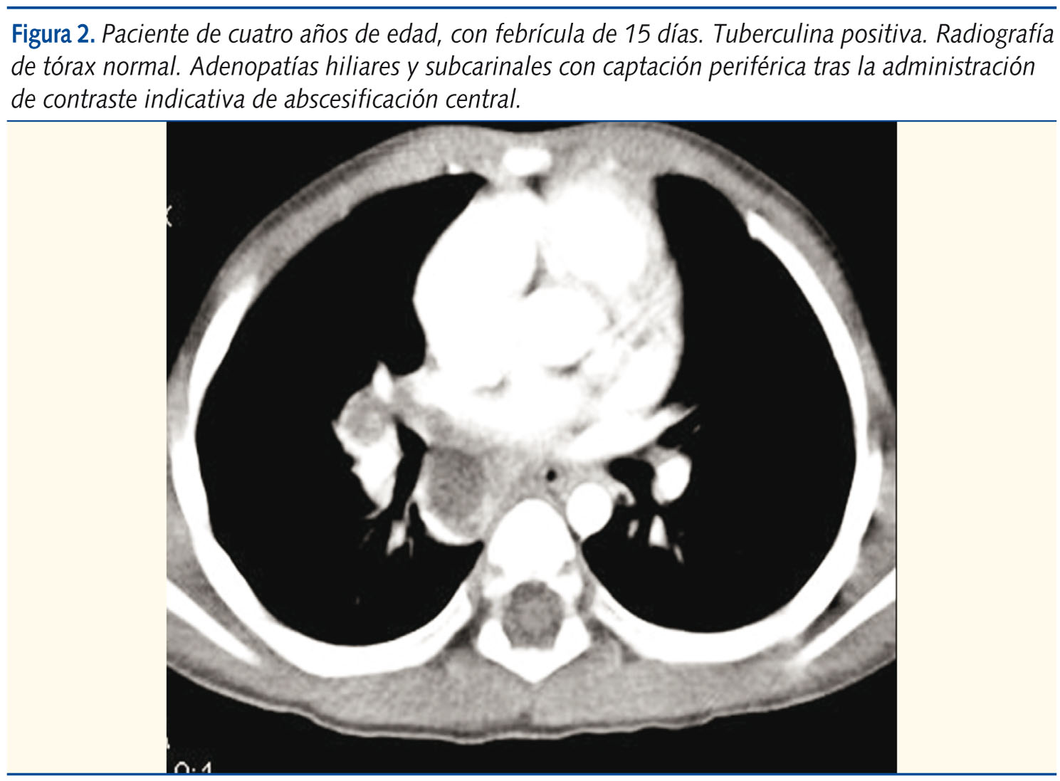Figura 2. Paciente de cuatro años de edad, con febrícula de 15 días. Tuberculina positiva. Radiografía de tórax normal. Adenopatías hiliares y subcarinales con captación periférica tras la administración de contraste indicativa de abscesificación central