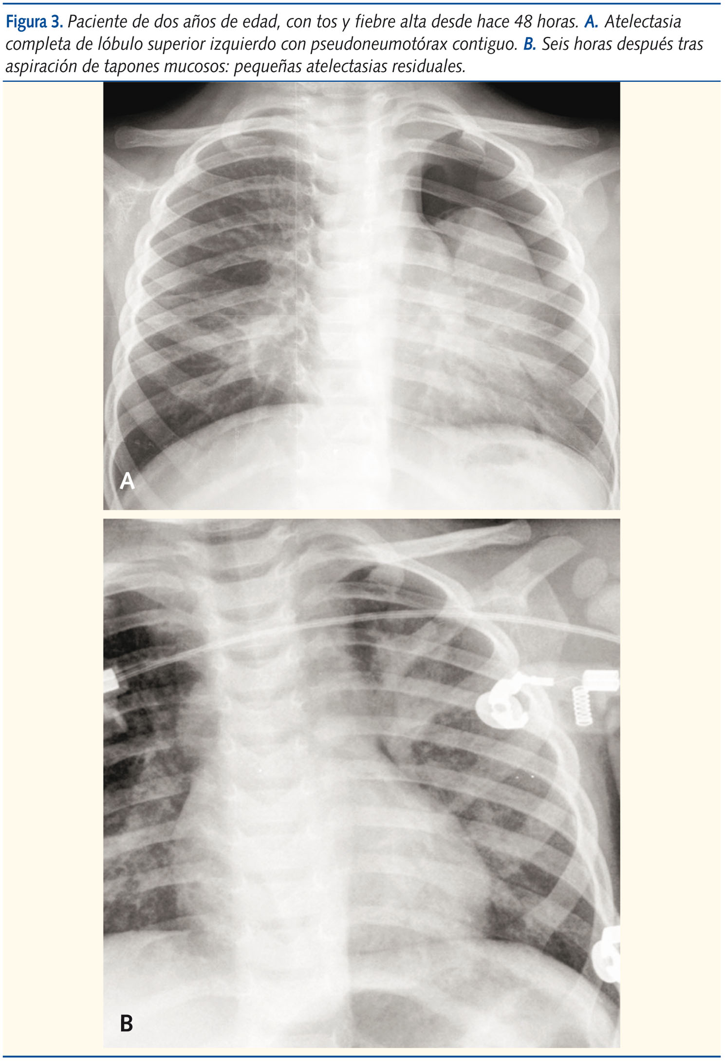 Figura 3. Paciente de dos años de edad, con tos y fiebre alta desde hace 48 horas. A. Atelectasia completa de lóbulo superior izquierdo con pseudoneumotórax contiguo. B. Seis horas después tras aspiración de tapones mucosos: pequeñas atelectasias residual