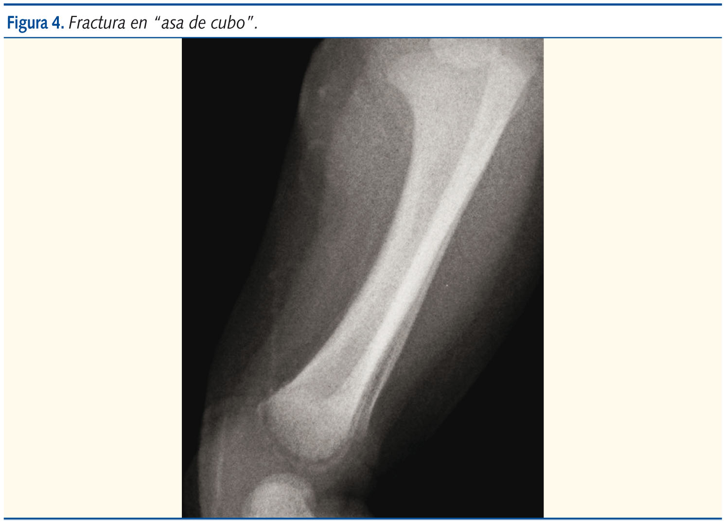 Figura 4. Fractura en “asa de cubo”