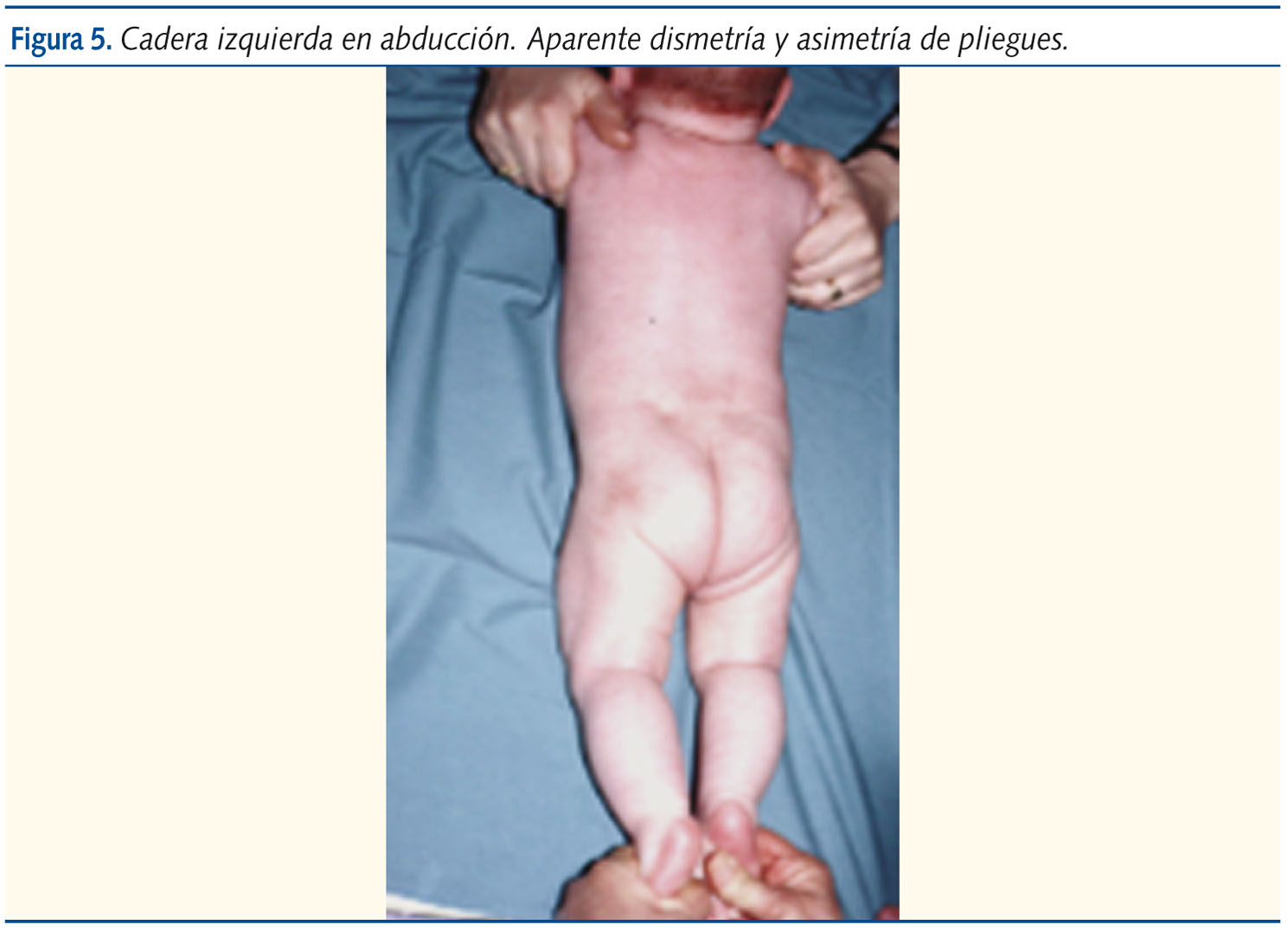 Figura 5. Cadera izquierda en abducción. Aparente dismetría y asimetría de pliegues