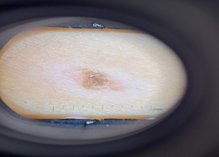Figura 1. Fotografía con dermatoscopio acoplado al móvil