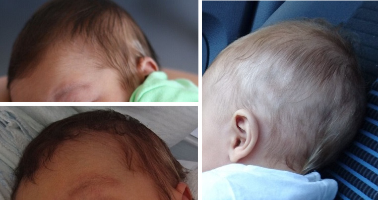 Figura 1. Aspecto de las lesiones durante los 3 primeros meses de vida del paciente