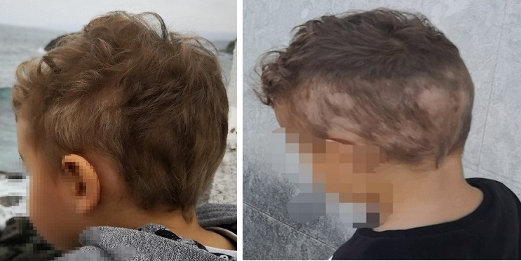 Figura 2. Aspecto de las lesiones a los 5 años de vida del paciente