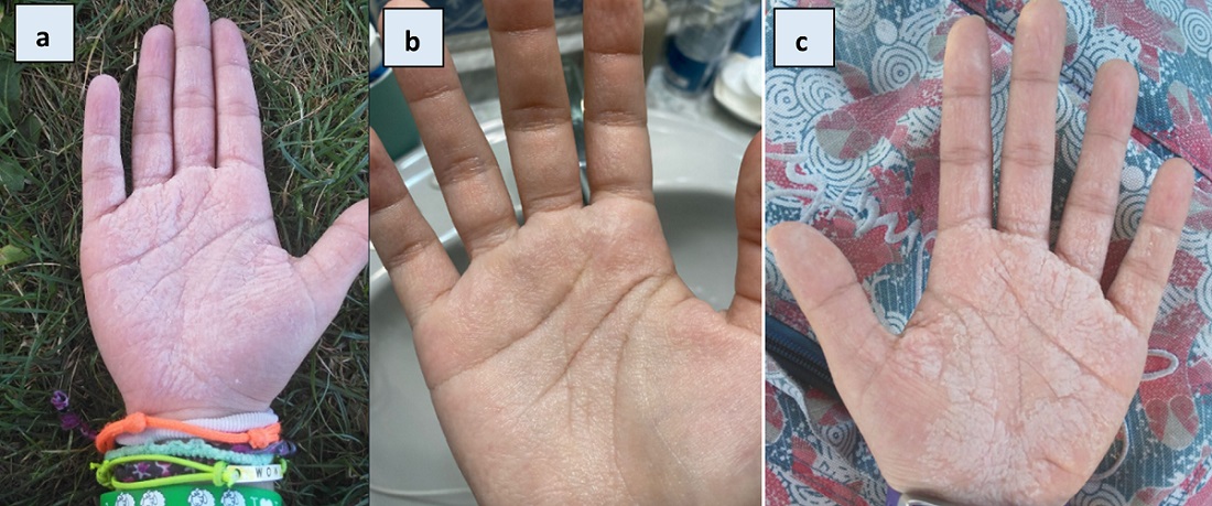 Figura 1. Imágenes de queratodermia acuagénica