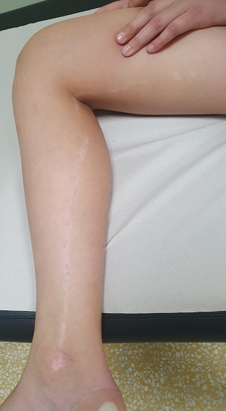 Figura 1. Líneas de Blaschko desde la cara interna de maleolo tibial hasta muslo