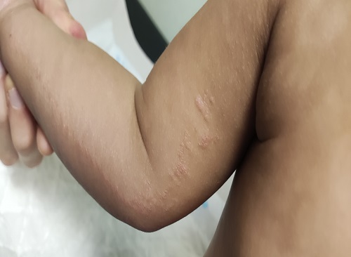 Figura 2. Liquen estriado, localizado en cara interna de brazo izquierdo