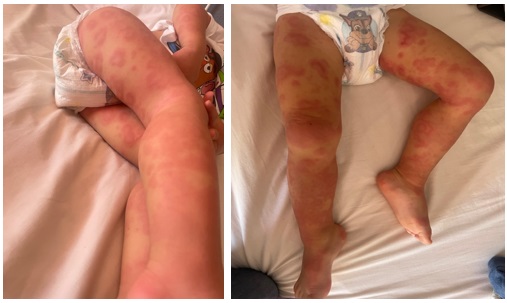 Figura 1. Pacientes con urticaria multiforme