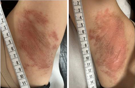 Figura 1. Placas eritematosas levemente descamativas, no nacaradas; en periferia, ligera costra seca posexudativa