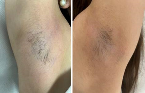 Figura 2. Resolución completa de las lesiones tras tratamiento