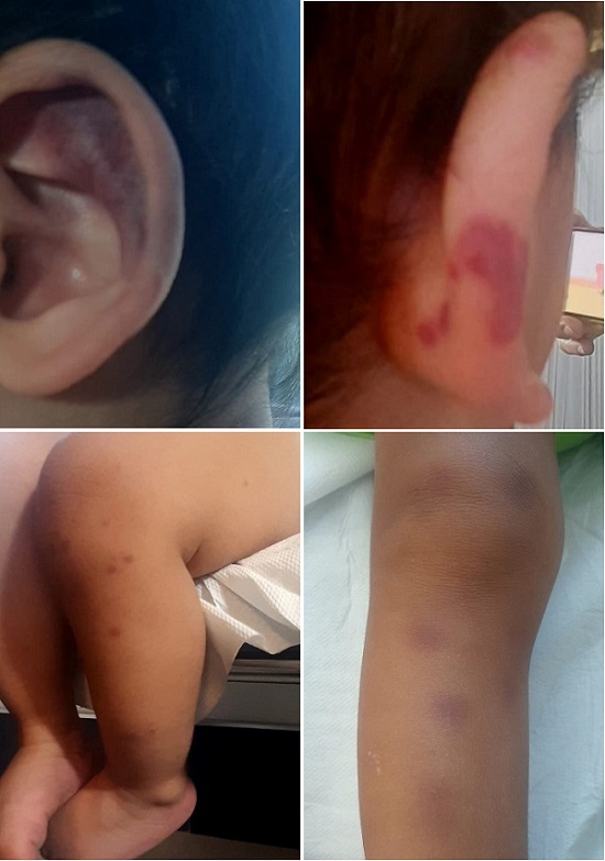 Lesiones maculo-purpúricas palpables de rápida evolución que comenzaron en pabellón auricular con posterior extensión a extremidades inferiores