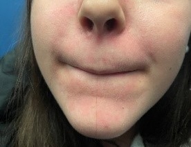 Figura 2. Eritema residual posinflamatorio