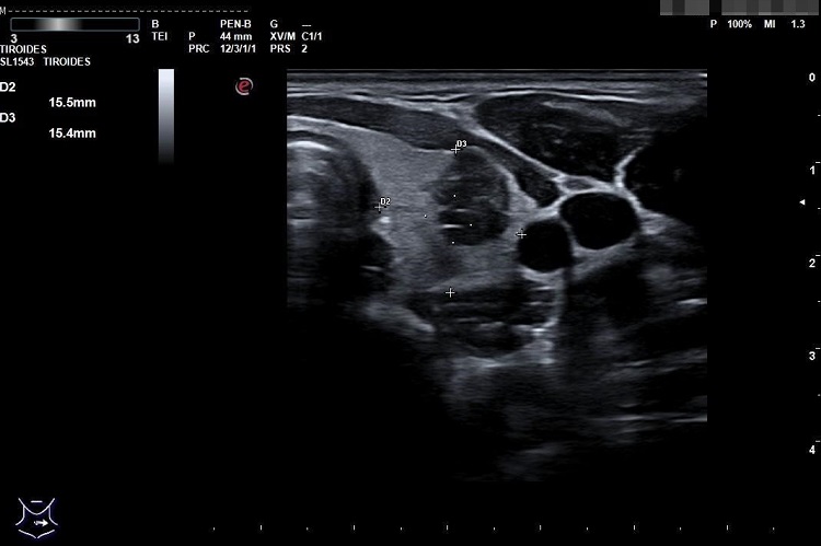 Figura 1. Ecografía tiroidea. Nódulo en lóbulo tiroideo izquierdo, clasificación TIRADS 5