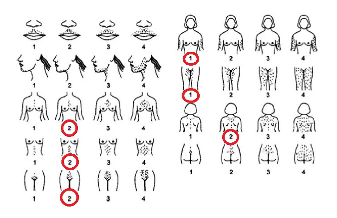 Figura 1. Escala Ferriman-Galleway modificada 