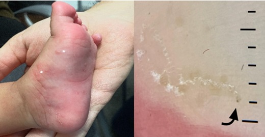 Figura 1. Izquierda: nódulos escabióticos (asteriscos). Derecha: surco acarino con signo del ala delta (flecha).