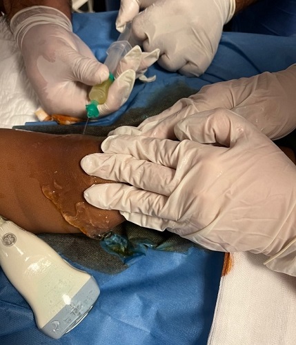 Figura 1. Artrocentesis ecoguiada.