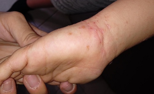 Figura 1. Lesiones papuloeritematosas en muñeca con lesiones de rascado colindantes