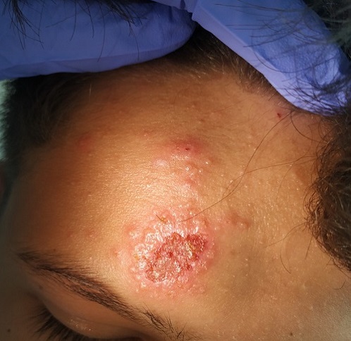  Figura 1.  Lesión de 3 días de evolución.