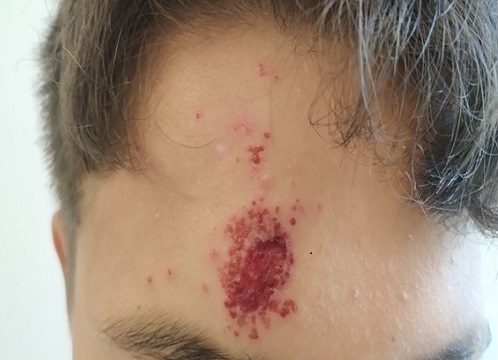 Figura 2. Evolución favorable de la lesión tras 7 días de tratamiento