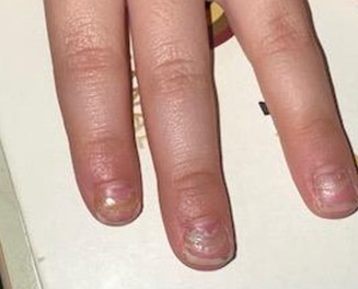 Figura 1. Lámina ungueal distal engrosada, que está siendo reemplazada en la zona proximal por una de aspecto normal