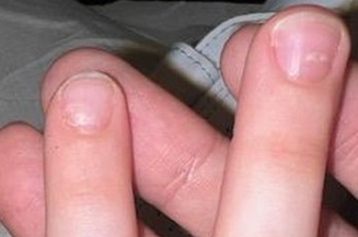 Figura 2. Despegamiento de la lámina ungueal