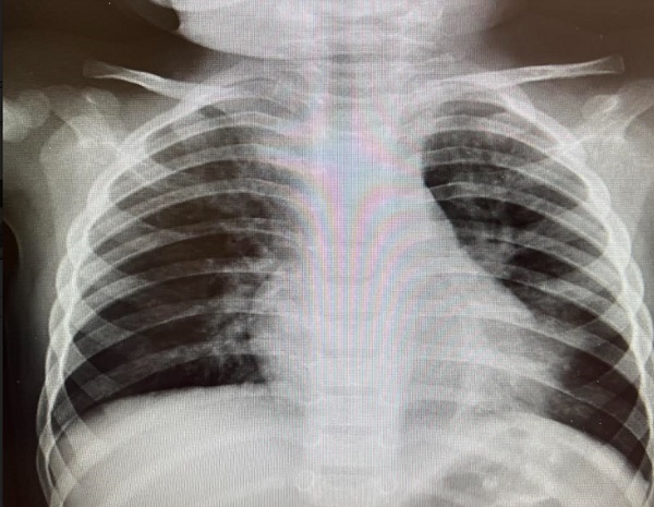 Figura 2. Neumonía atelectasia de LII