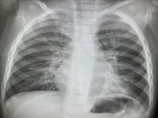 Figura 3. Neumonía atelectasia persistente en LII