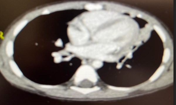 Figura 4. Hallazgos sugestivos de proceso infeccioso broncoalveolar; atelectasia paracardiaca en língula