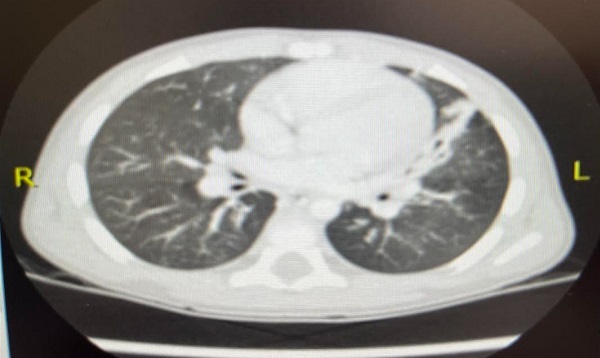 Figura 4. Hallazgos sugestivos de proceso infeccioso broncoalveolar; atelectasia paracardiaca en língula