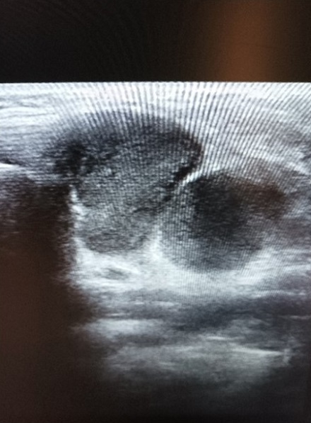 Figura 1. Ecografía: dos formaciones bien delimitadas, hipoecogénicas, con flujo Doppler, sin hilio visible
